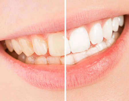 Blanqueamiento Dental