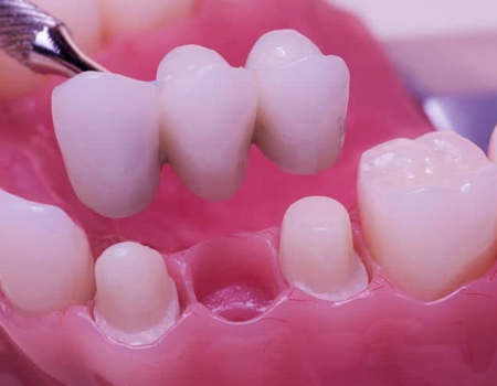 Puentes Dentales