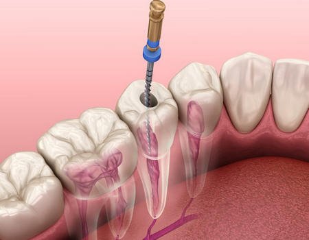 Endodoncia